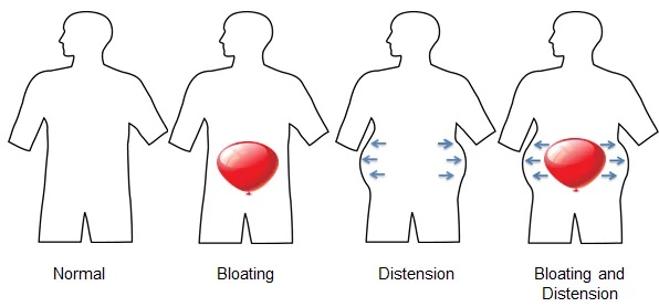 밥 먹고 배가 빵빵하거나 식후 더부룩함이 반복되나요? 복부팽만의 원인부터 기능성소화불량, 과민성대장증후군, 위장 운동과 뇌-장 축의 관계, 검사와 치료 방법까지 알아봅니다.