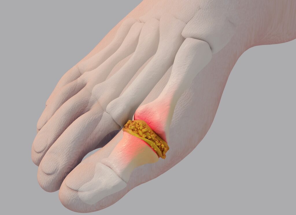 이러한 증상에서 먼저 생각하는 질환 중 하나가 통풍(Gout)입니다. 통풍은 혈액 속 요산이 관절에 결정 형태로 쌓이고, 이에 대한 면역반응으로 갑작스러운 염증이 발생하는 질환입니다. 다만 엄지발가락이 붉고 뜨겁게 부었다면 감염성 관절염도 함께 확인해야 합니다. 처음 경험하는 심한 관절 통증이라면 증상만으로 판단하지 말고 병원에서 진단받으시는 것이 좋습니다. 오늘은 통풍이 유독 엄지발가락에 잘 발생하는 이유부터 요산 결정의 염증 기전, 초음파 검사, 급성 통풍 치료와 재발 예방까지 설명드리겠습니다.