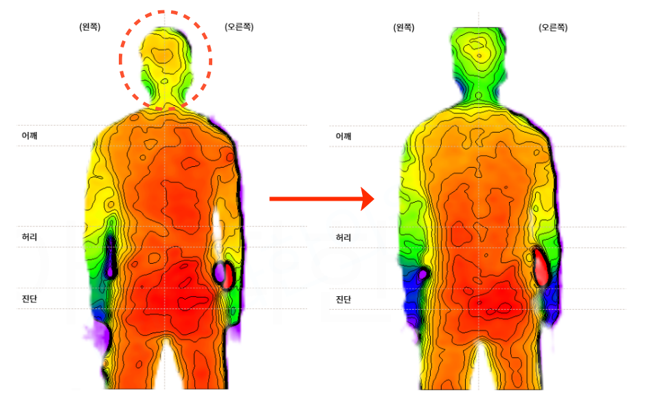 아나파한의원 호전 변화 이미지 - 식후 두근거림과 어지럼증 관련 시각 자료